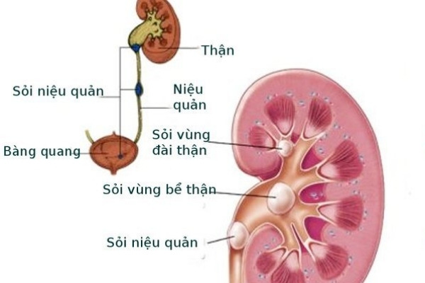 Sỏi niệu quản là căn bệnh liên quan đến đường tiết niệu