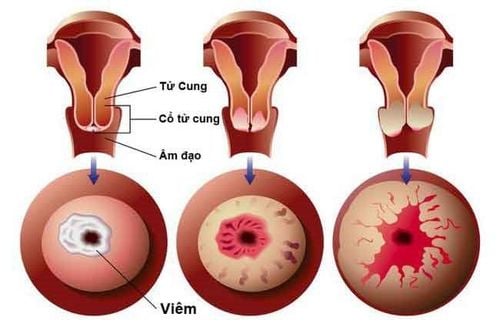 Viêm lộ tuyến cổ tử cung do một loại nấm, vi khuẩn hoặc ký sinh trùng gây ra.