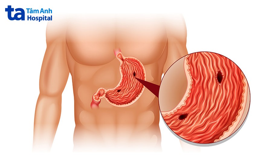 bệnh dạ dày thường gặp