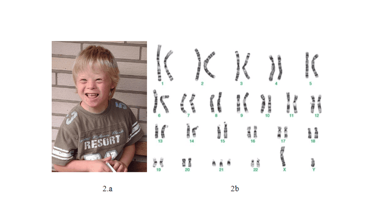 Hình 2.a: Cậu bé 8 tuổi mắc hội chứng Down (Wikipedia) Hình 2.b: Karyotype của nam giới mắc hội chứng Down (Karyotype Analyses of Down Syndrome Children in East Priangan Indonesia)