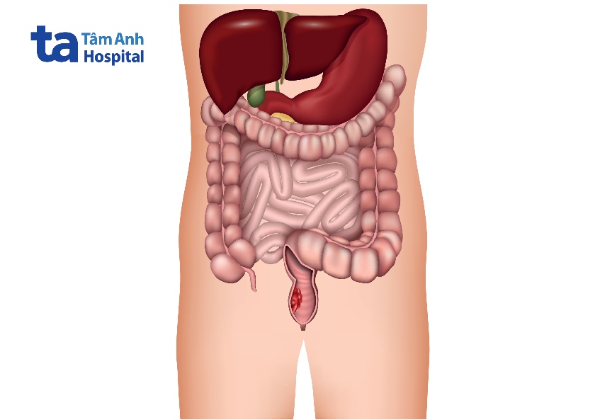 biểu hiện ung thư trực tràng trong hệ tiêu hóa