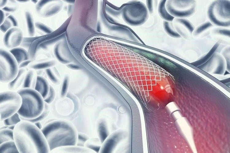 Nong và đặt stent động mạch vành.