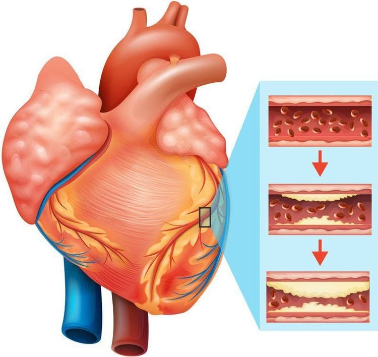 Bệnh mạch vành gây ra do sự tích tụ mảng bám trong lòng động mạch.