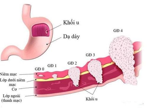 Ung thư dạ dày theo từng giai đoạn