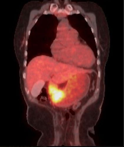 Hình ảnh tăng chuyển hóa trên phim chụp PET ở vùng dạ dày do ung thư