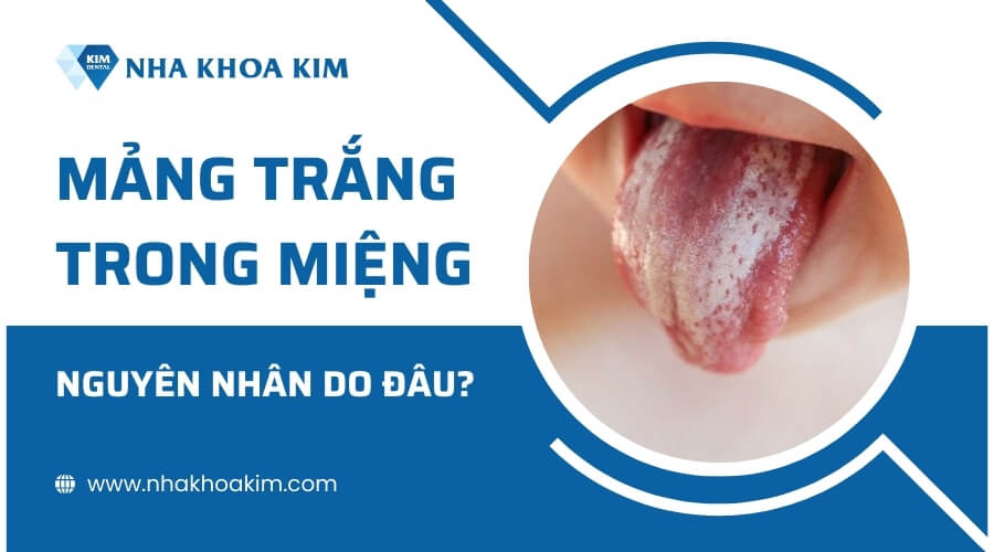 Nguyên nhân xuất hiện mảng trắng trong miệng