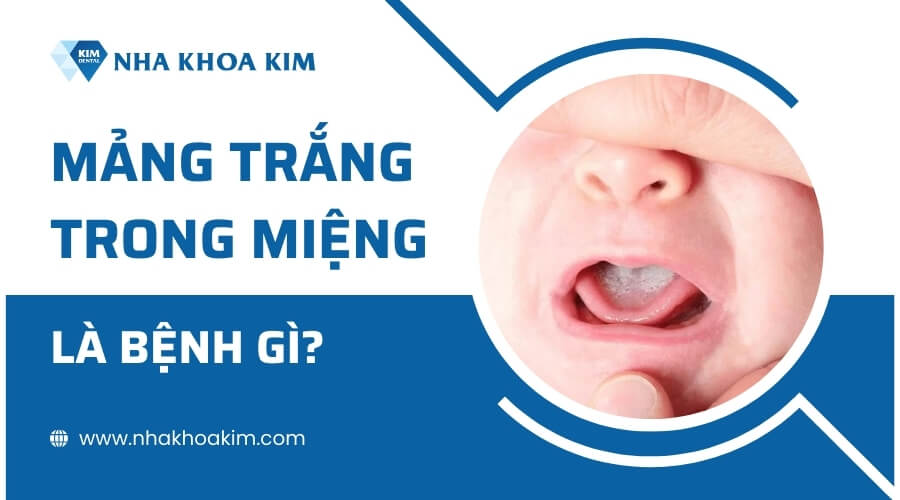 Mảng trắng trong miệng là bệnh gì? 