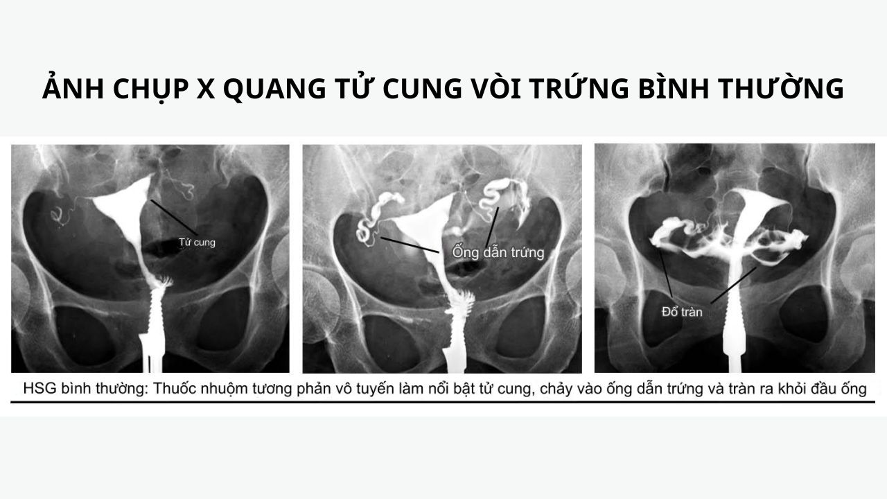 (Hình 2 - Ảnh chụp X Quang khảo sát tử cung, vòi trứng và vùng chậu bình thường)