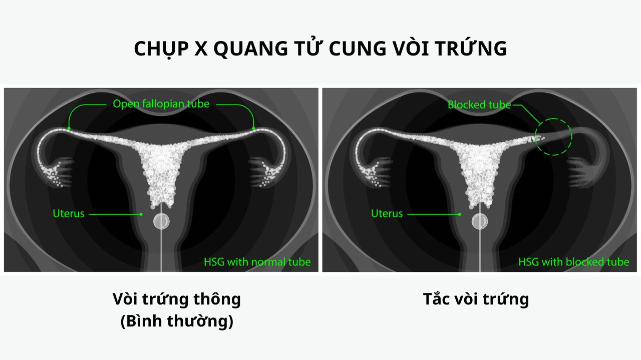 (Hình 1 - Ảnh chụp X Quang tử cung vòi trứng bình thường (trái) và tắc vòi trứng (phải))