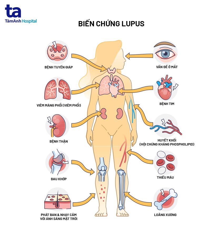 biến chứng lupus