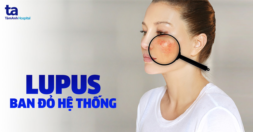 lupus ban đỏ hệ thống