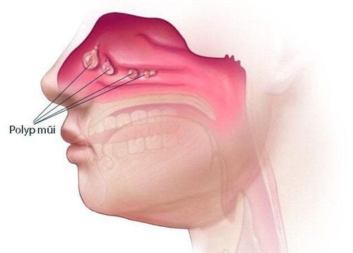 Polyp mũi là một trong các nguyên nhân khiến bạn bị mất khứu giác