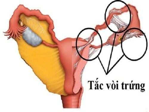 Mổ thông tắc vòi trứng thường được chỉ định khi có tình trạng tắc nghẽn vòi trứng