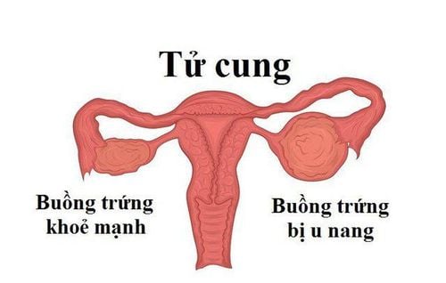 U nang buồng trứng là căn bệnh rất dễ gặp ở phụ nữ trong độ tuổi sinh sản