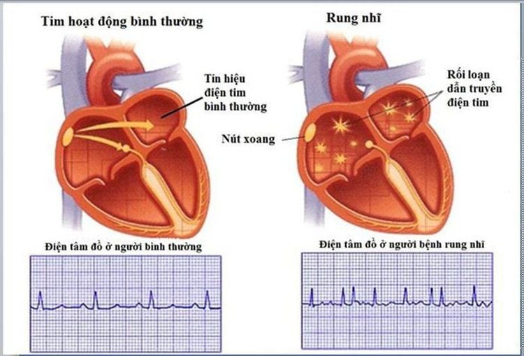 Rung nhĩ là một dạng rối loạn nhịp tim trên thất thường gặp nhất