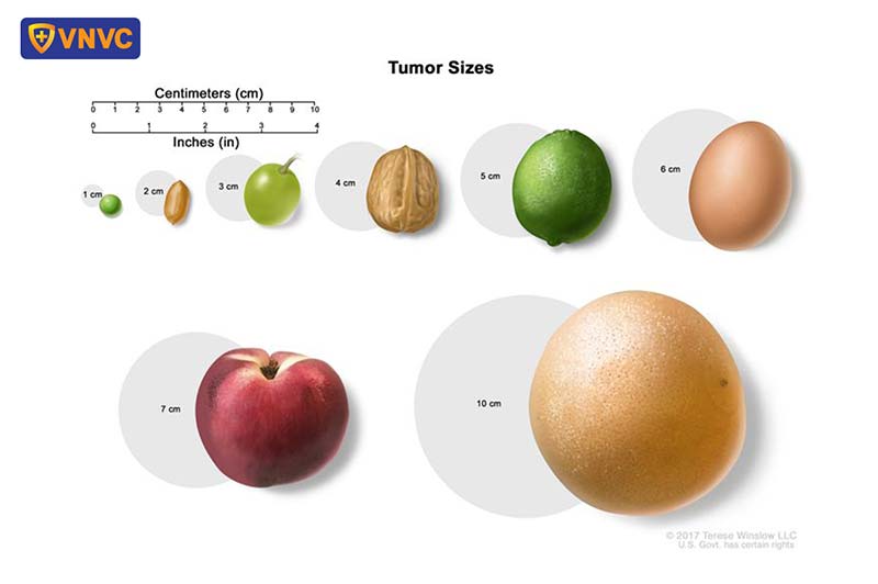 mô tả kích thước ung thư vòm họng
