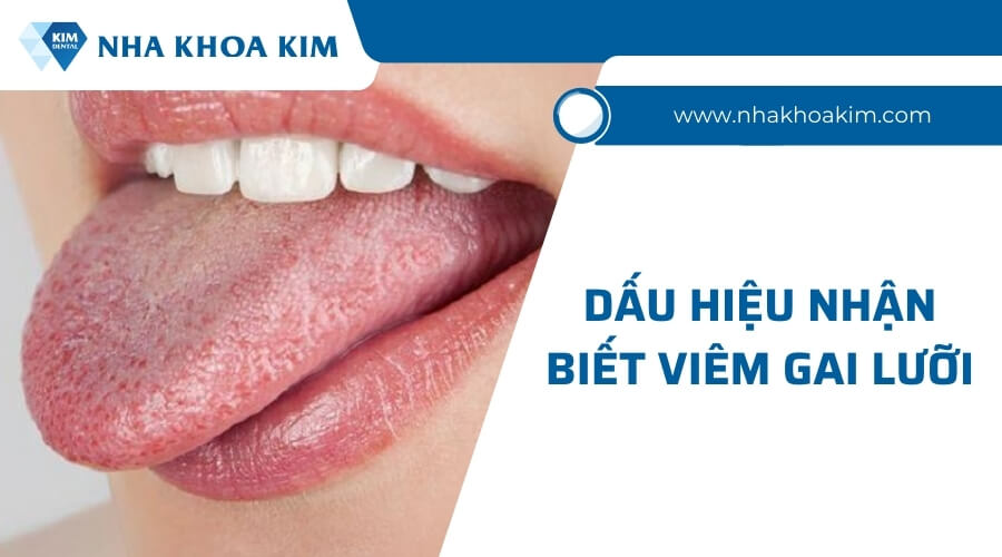 Dấu hiệu nhận biết bệnh viêm gai lưỡi