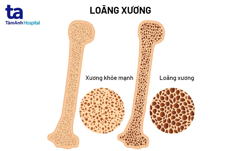 loãng xương