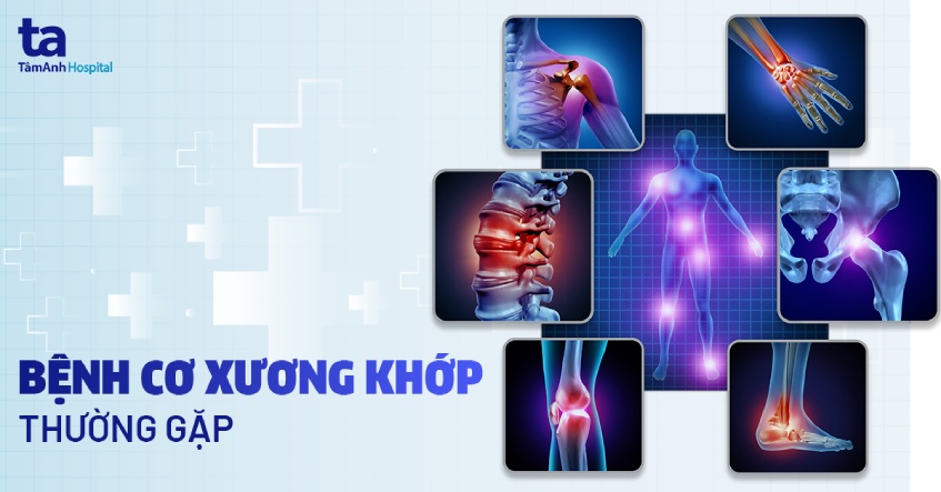 các bệnh cơ xương khớp