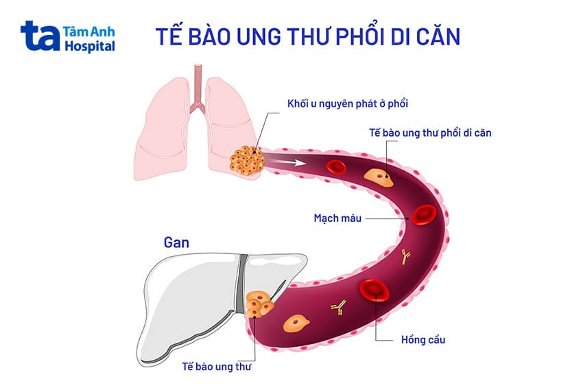 quá trình ung thư di căn