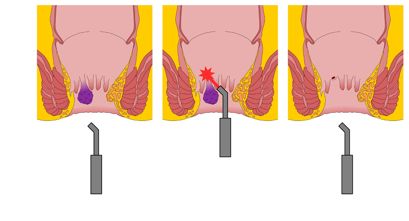 Các phương pháp điều trị bệnh trĩ mới nhất hiện nay 3