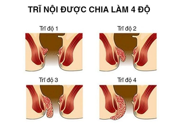 Bệnh trĩ được chia làm những cấp độ khác nhau