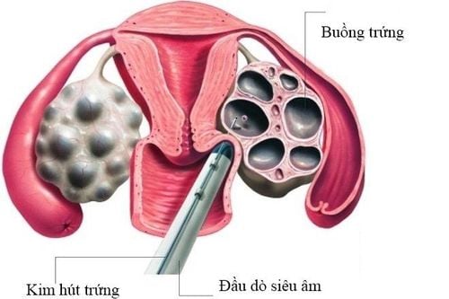 Hình ảnh mô phỏng kỹ thuật chọc hút trứng