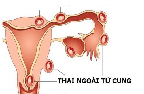 Thai ngoài tử cung cũng khiến thai nhi không giữ được