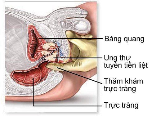 Tiêu thụ một lượng lớn sữa có thể làm tăng nguy cơ mắc bệnh ung thư tuyến tiền liệt