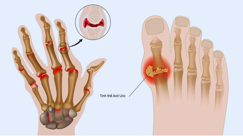 3-loai-thuoc-tri-gout-cap-ma-ban-phai-nam-long-44851 1.png