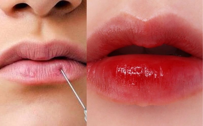 Tiêm filler môi giúp cho đôi môi trở nên căng mọng, quyến rũ