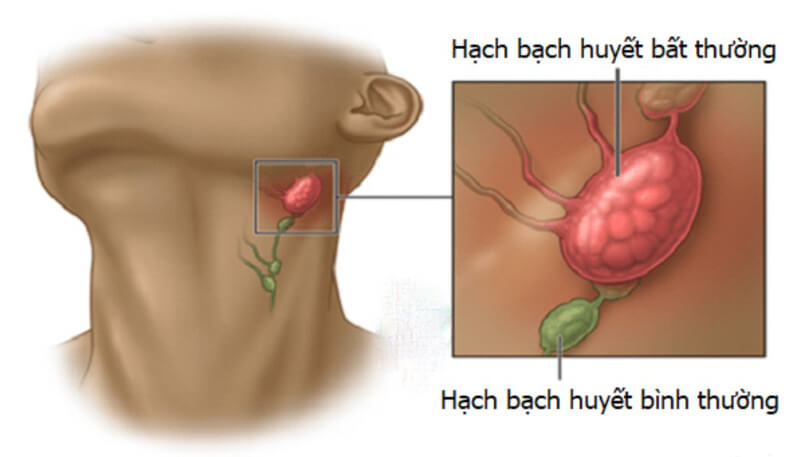 Người bị máu trắng thường xuyên đau xương khớp và mệt mỏi