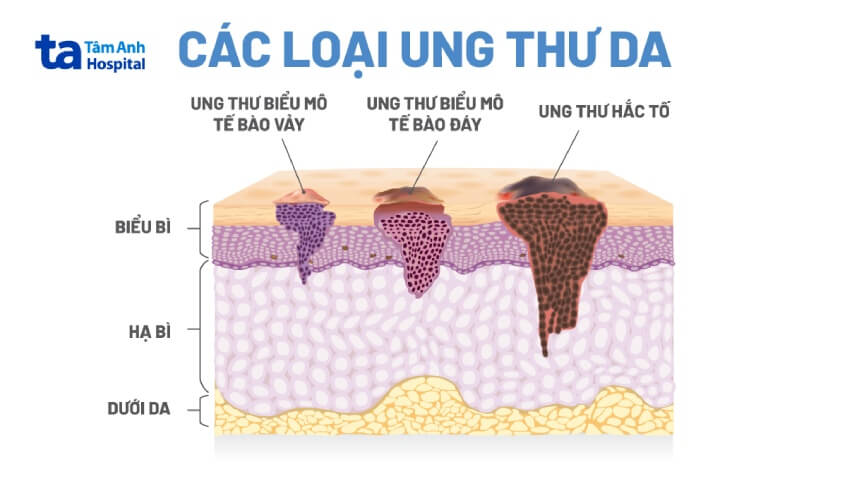 ung thư sắc tố có nguy hiểm không