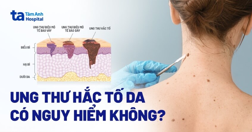 ung thư hắc tố da có nguy hiểm không