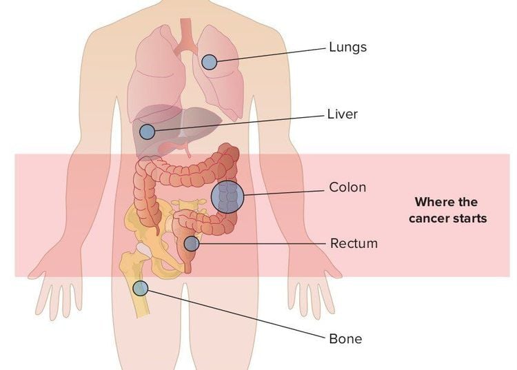 Ung thư trực tràng giai đoạn cuối là giai đoạn ung thư lan ra các vị trí khác trong cơ thể