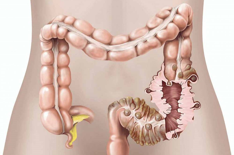 Tìm hiểu về đại tràng và những bệnh thường gặp ở đại tràng 4