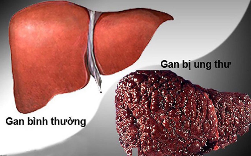 Góc hỏi đáp: Bệnh viêm gan B có di truyền không?