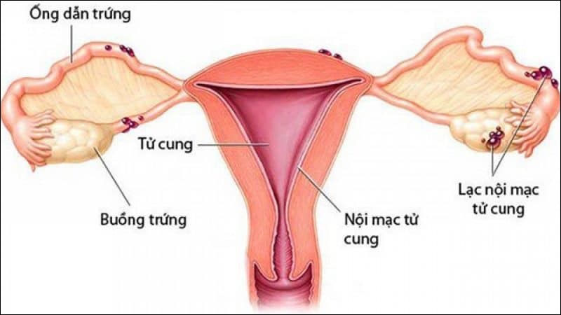 Lạc nội mạc tử cung xuất hiện tình trạng 1 tháng có kinh 2 lần