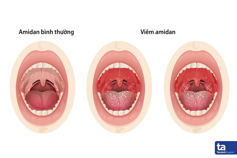 Viêm amidan mãn tính