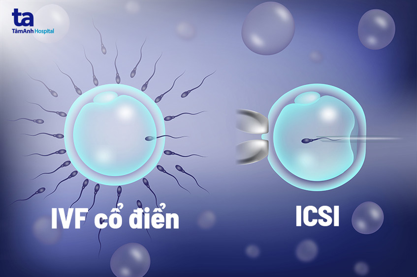 ivf cổ điển so với icsi