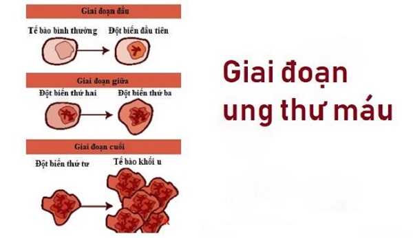 Bệnh ung thư máu sống được bao lâu phụ thuộc vào giai đoạn của bệnh