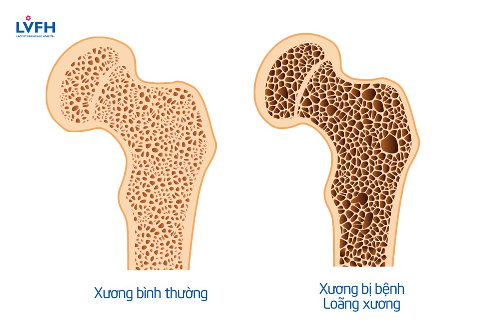 Bệnh loãng xương thường diễn tiến âm thầm