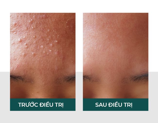 Hiệu quả rõ rệt sau khi thực hiện liệu trình Derma Acne Care tại VITA Clinic