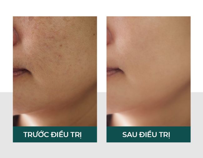 Da căng mịn và mờ thâm sau liệu trình Laser Skin Health