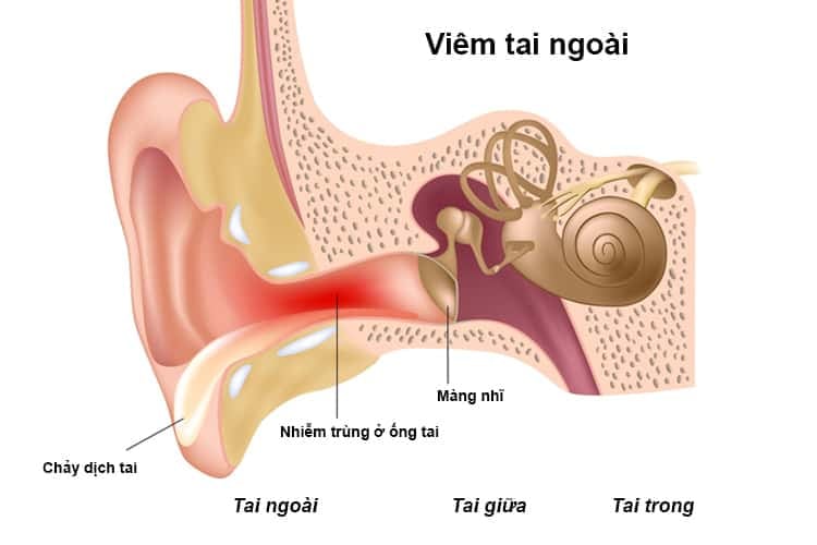 Cách chữa viêm tai ngoài tại nhà