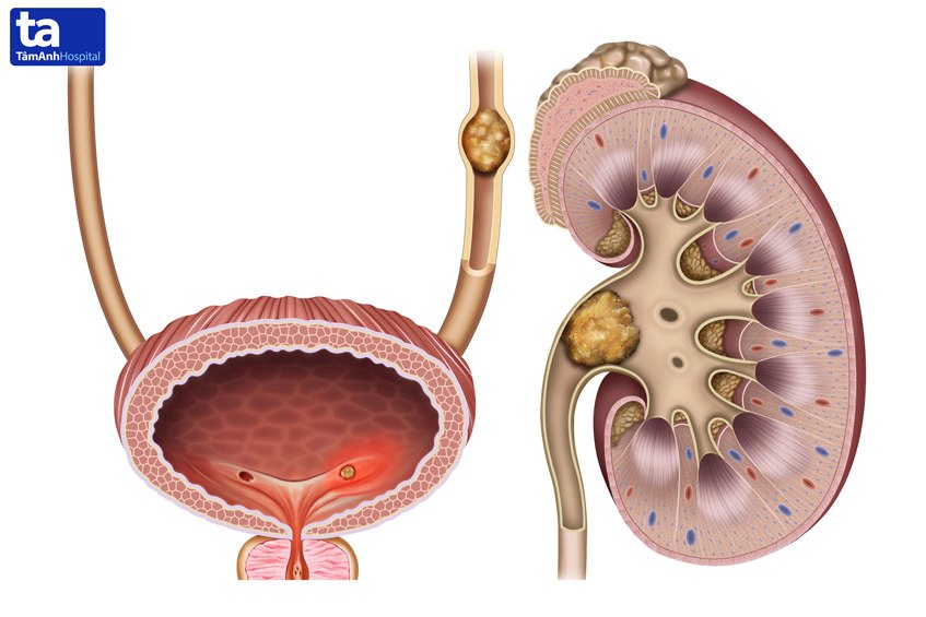 cơn đau sỏi thận là gì