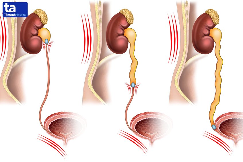 nhận biết cơn đau do sỏi thận