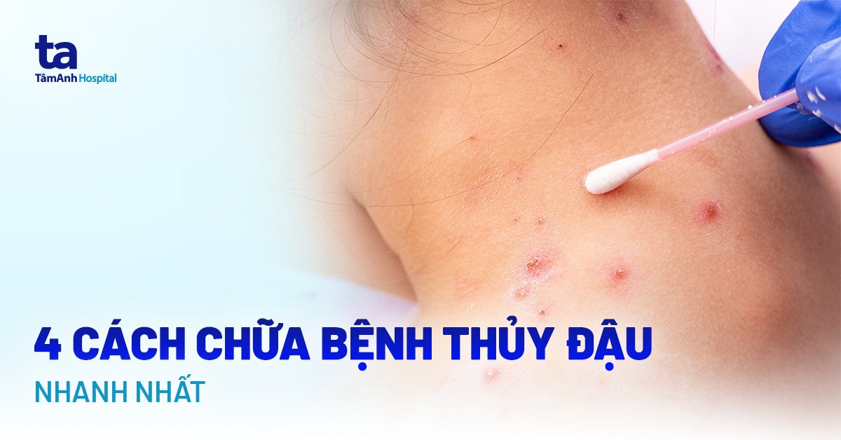 cách chữa bệnh thủy đậu nhanh nhất