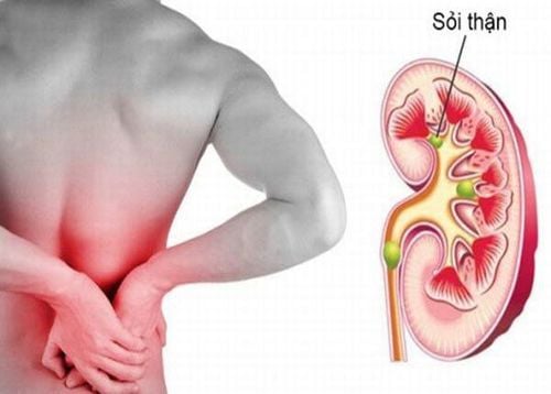 Sỏi thận là một trong những nguyên nhân gây bệnh thận ứ nước