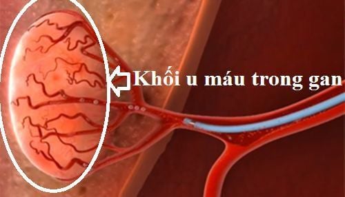 Bệnh u máu gan là bệnh lành tính không gây nhiều nguy hiểm cho người bệnh